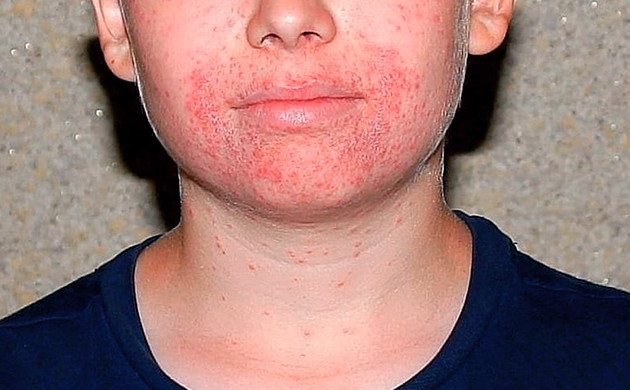 Красная сыпь а нижней части лица подростка